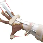 Dynamic Extension Splint